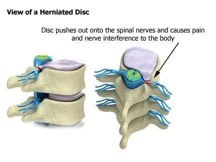 diagram of herniated disc