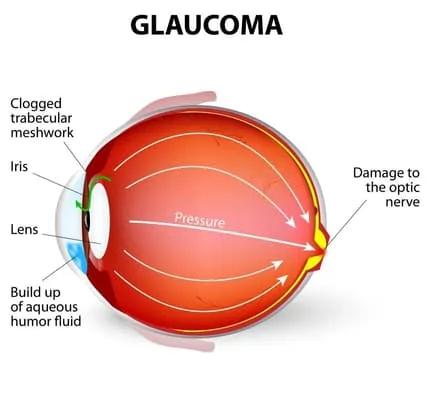 Glaucoma treatment Kissimmee Eye Doctor