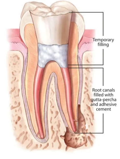 Tooth With Procedure Done