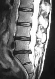 Herniated Disc