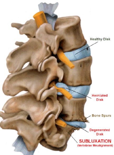 subluxation1.gif