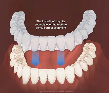 Invisalign | Dentist In Fircrest, WA | Emerson Dental