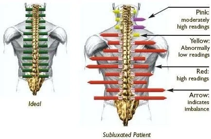 misalignment, muscle spasm, myovision scan, spinal manipulation, fort lauderdale chiropractor, fort lauderdale spinal adjustment