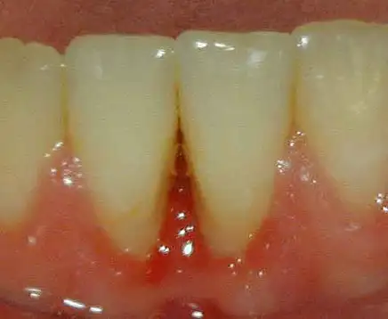 Pittsburgh periodontist picture of osteonecrosis of the jaw after treatment