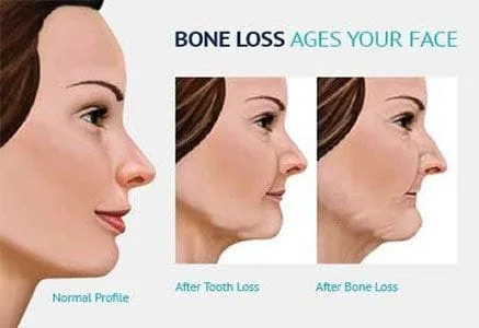 Bone Loss After Tooth Loss