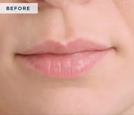 Before Restylane®