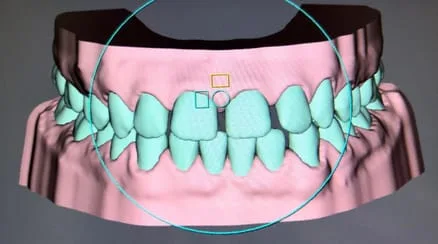 computer rendering of top and bottom teeth with gaps, showing state of teeth before treatment with SureSmile New Baltimore, MI
