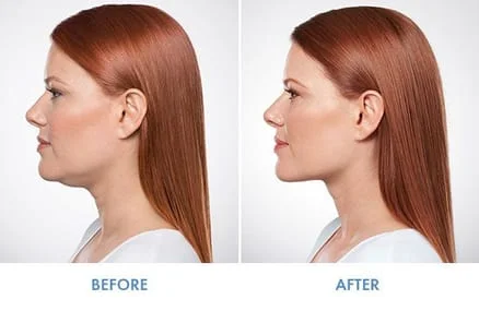 Kybella Double Chin Elimination  Dermatologist In Toledo, OH