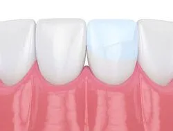 illustration of teeth, one with bonding on it fixing crack, dental bonding Kearney, NE dentist