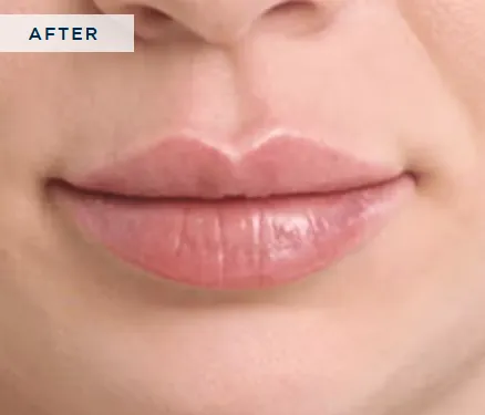 After Restylane®