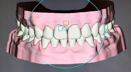 computer rendering of top and bottom teeth straight with no gaps, showing teeth after treatment with SureSmile clear aligners New Baltimore, MI