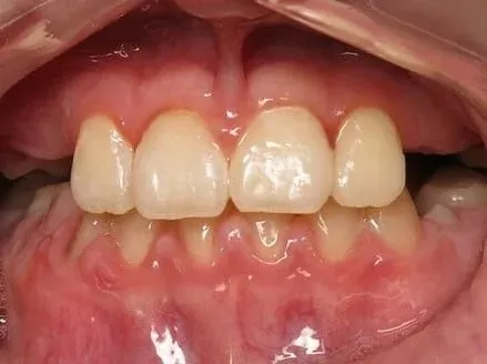 Severe underbite after