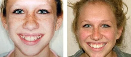 Orthodontics Palatine IL, Before and After