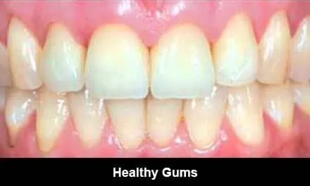 Healthy Gums