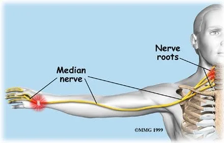 Carpal Tunnel Syndrome - Albuquerque, NM: Modern Pain & Spine