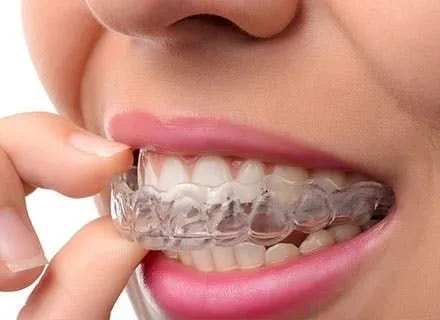 Invisalign® - Roswell, GA Dentist | iSmile Dental