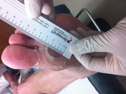 Diabetic Wound Before Dermagraft