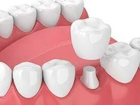 illustration of lower teeth, crown being placed over one tooth, dental crowns Kearney, NE dentist