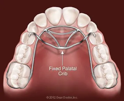 fixed-palatal-crib