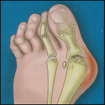 arthritis in feet