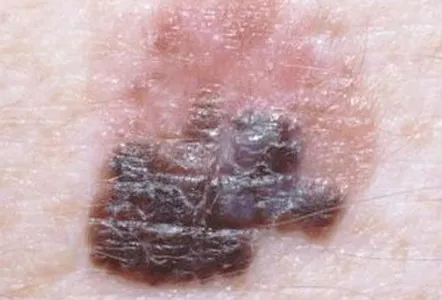 Skin Cancer