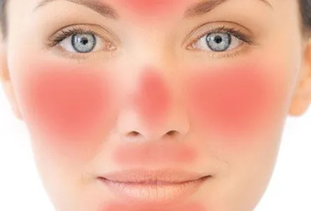 Rosacea