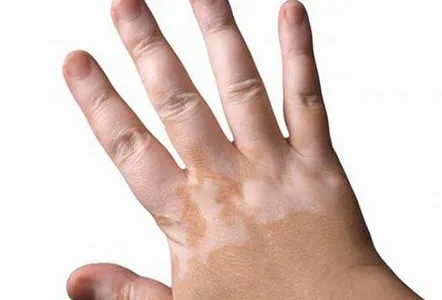 Vitiligo