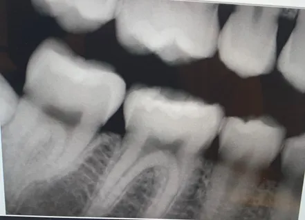 moderate periodontitis radiograph