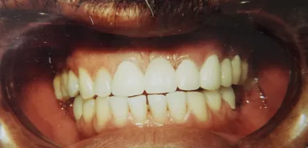 After Cosmetic Dentistry, San Marcos