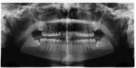 Wisdom Teeth X-Ray