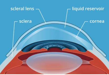 Scleral