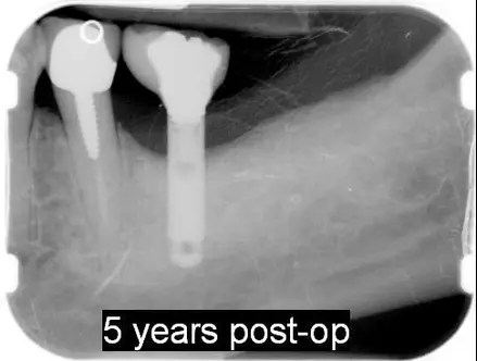 implanitits po 5 year post-op