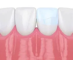 illustration of dental bonding repairing cracked tooth, cosmetic dentistry Montclair, NJ dentist