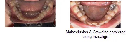 before and after results of tooth crowding fixed by dentist in Newark, CA with Invisalign