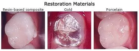 Examples of Restoration Materials
