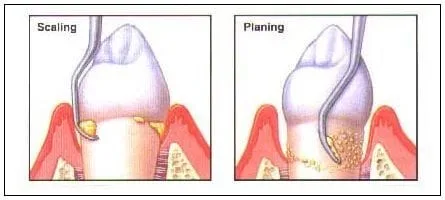 scaling and root planing manchester nh dentist