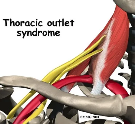 Thoracic Outlet