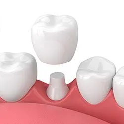 illustration of crown being placed over prepared tooth in mouth, dental crowns Novi, MI dentist