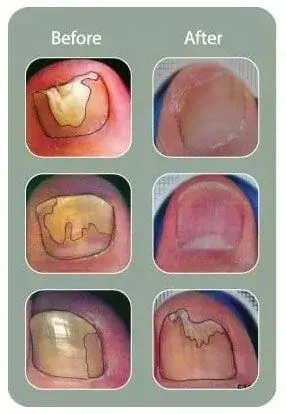 before and after genesis plus treatment