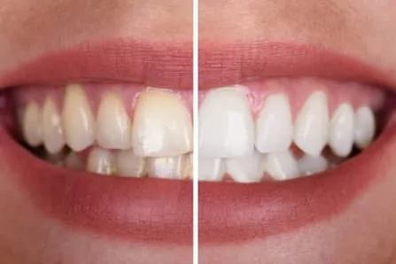 Photograph of smile showing before and after Teeth Whitening, Louisville, KY