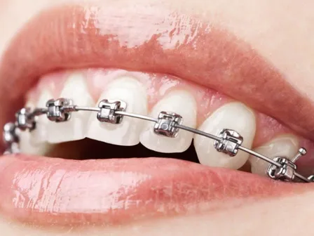 braces