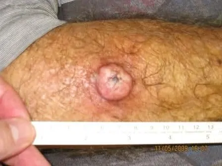 Skin Cancer Before