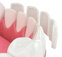 3D illustration of veneer pieces floating in front of lower teeth about to be placed, dental veneers Kearney dentist
