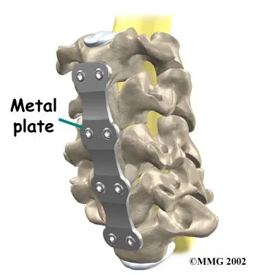 cervical_corpectomy_strut_surgery02.jpg