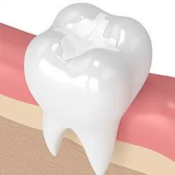 illustration of tooth with composite tooth-colored filling in it, cosmetic dentistry Financial District, NY dentist