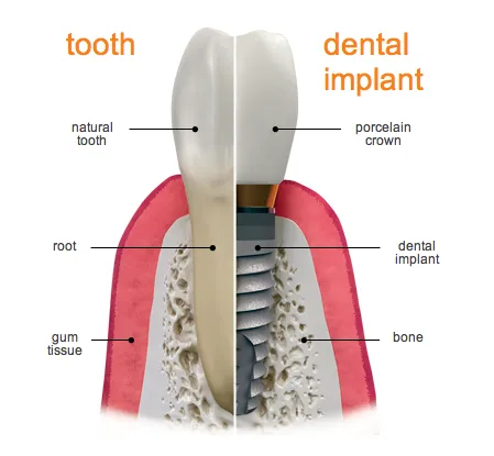 Dental Implant 1