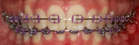 purple and teal braces