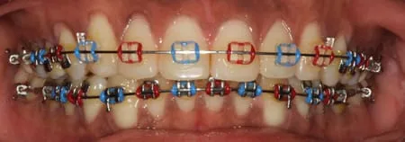Blue and Red Colour Braces