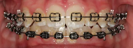 Red and black deals braces