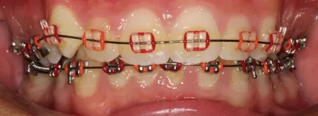 blue colored braces